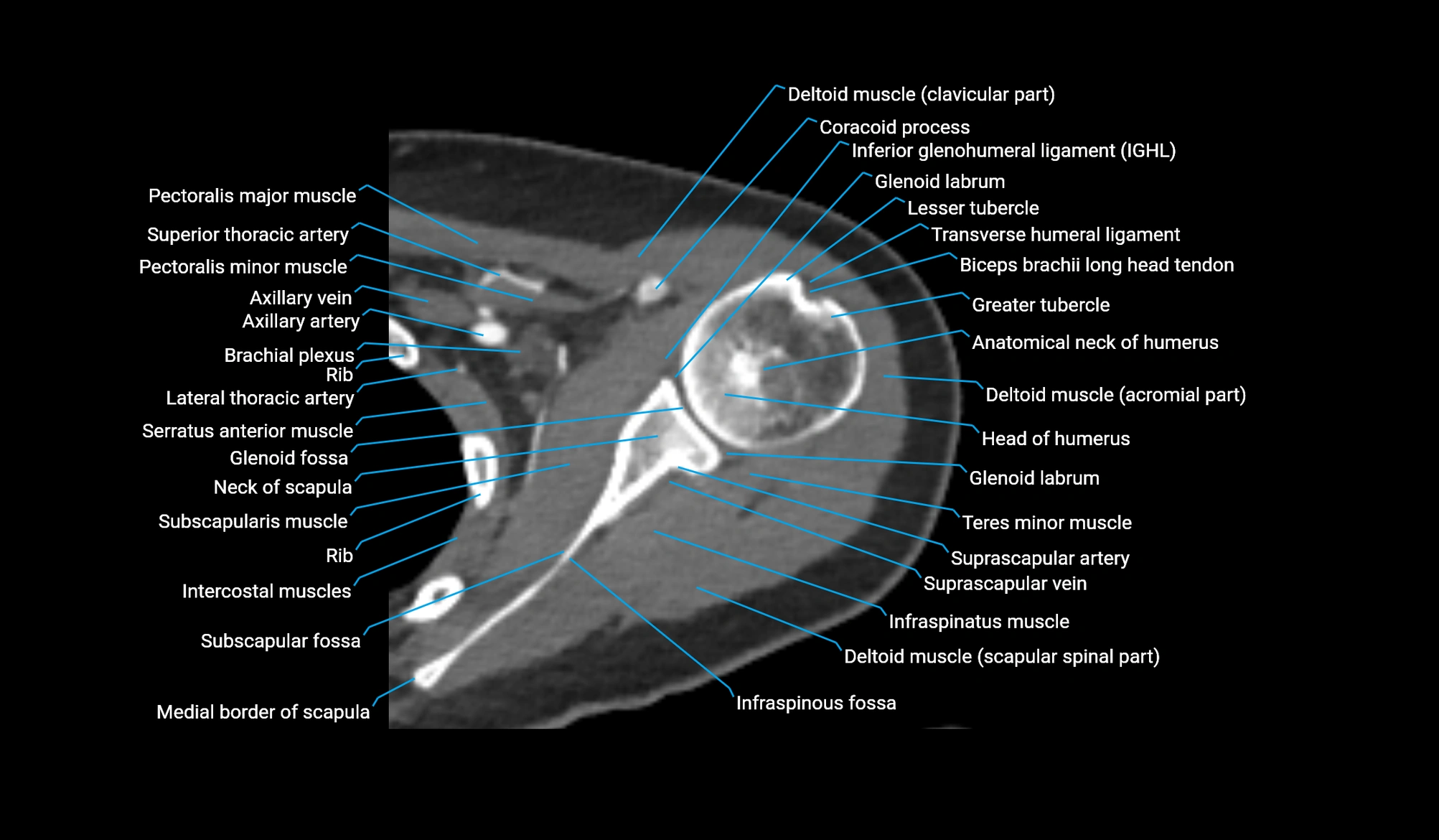 CT upper arm axial  cross sectional anatomy labelled radiology image -00094.webp